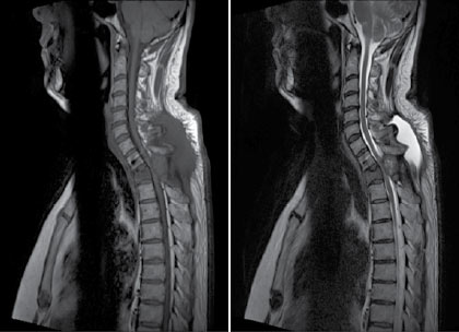Figura 3. Imagen de la izquierda: secuencia T1. Imagen de la derecha: secuencia T2. Ambas sin contraste, corte sagital. En las imágenes se aprecia lesión que causa disminución de la amplitud del canal vertebral y compresión del canal medular, que se ve con mayor exactitud en secuencia T2, donde se resalta el espacio medular. Además, se observa, cambios en la altura del cuerpo vertebral