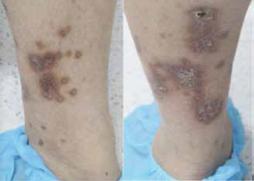 Figura 6. Se evidencia de manera bilateral asimétrica placas pardo-violáceas que confluyen formando grandes placas de bordes bien definidos con descamación fina en su superficie