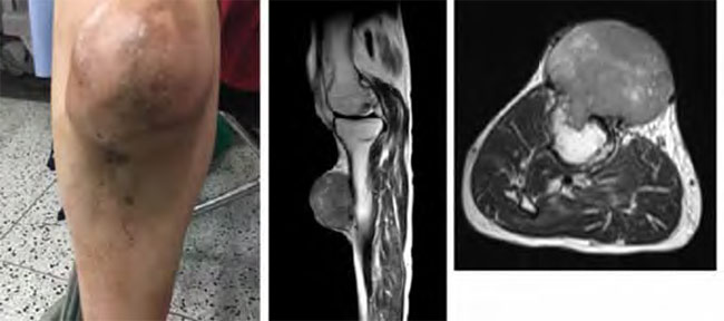 Figura 1. A. Fotografía de la lesión tumoral de 10 cm de diámetro en la porción proximal de la pierna derecha del paciente. B y C. Imágenes por resonancia magnética de la pierna derecha en las que se ve una masa de aspecto neoplásico (flecha blanca), dependiente de la cortical anterior de la tibia con crecimiento hacia tejidos blandos y escaso crecimiento hacia la cavidad endomedular, múltiples fracturas trabeculares por insuficiencia en tibia y peroné