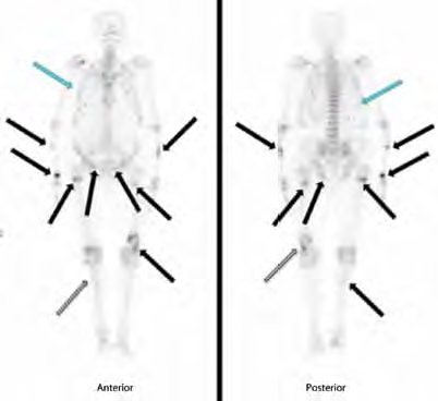 Figura 2. Gammagrafía ósea del paciente que muestra múltiples captaciones focales y alineadas en arcos costales, correspondientes a fracturas antiguas (flecha azules). Lesiones hipercaptantes en: diáfisis de cúbito derecho, en metadiáfisis de radio derecho, en tercio medio de la diáfisis del cúbito o radio izquierdo, en rama iliopúbica bilateral, en diáfisis proximal del fémur derecho, en diáfisis proximal del fémur izquierdo, fractura en tercio distal del fémur izquierdo (flechas negras). Incremento difuso de actividad de baja intensidad en el tercio proximal de la tibia derecha (flechas grises).
