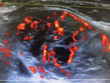 Figure 1. Mostly solid spongiform thyroid nodule with some cystic degeneration and increased vascularity