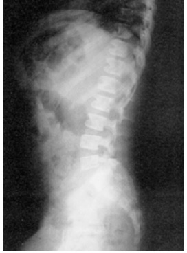 Vista lateral columna vertebral mostrando falta de