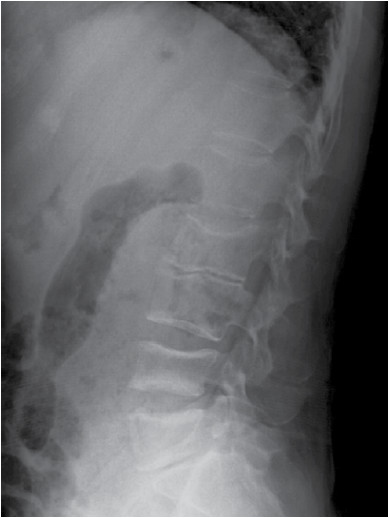 Figura 1. Fractura bicóncava de vértebra L2 con pérdida