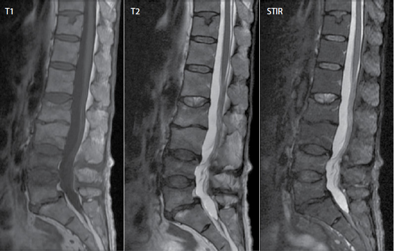 Figura 2. Las secuencias T1 y T2 configuración bicóncava de los cuerpos vertebrales con pérdida de altura e hipointensidad de la médula ósea por fracturas antiguas