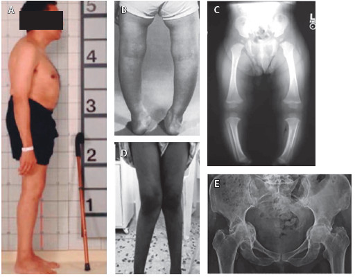 Figura 2. Signos clínicos de la osteomalacia. A. Cifosis, pectus carinatum. B y C. Genu varum. D. Genu valgum.