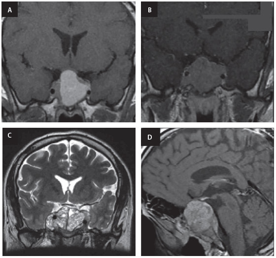 Figura 1. A. Resonancia magnética (RM) inicial (2007), corte coronal secuencia T1: macroadenoma hipofisiario de