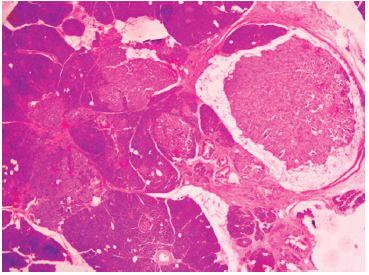 Figura 2. Histología de la insulinomatosis. Tinción de