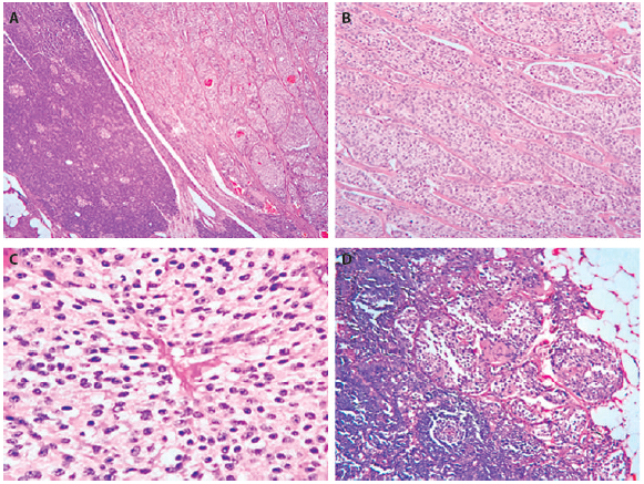 Figure 1. A. HE 4X Normal pancreatic parenchyma observed in the right half, with a neoplasic lesion observed in its well-defined left part, consisting of well differentiated nests of cells. B. HE 10X Solid nests of polygonal cells with salt-and-pepper chromatin nuclei. C. HE 40 X. Polygonal cells with salt-and pepper-nuclei. D. Lymph node metastasis.
