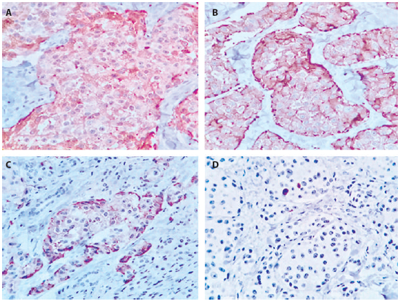 Figure 2. A. Chromogranin positive, B. Synaptophysin positive, C. Positive insulin marker, D. Low proliferation Ki- 67 marker