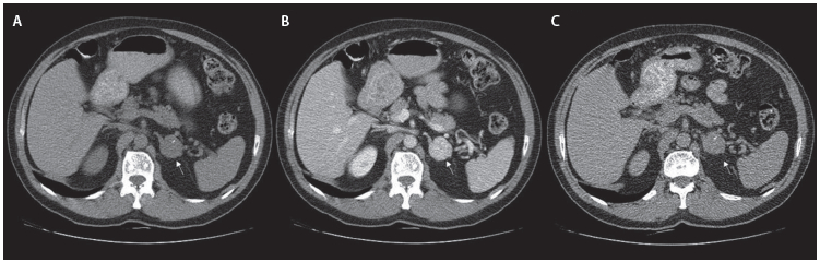 Figura 1. Tomografía de abdomen con protocolo para suprarrenales. La flecha blanca apunta a la lesión en las 3 fases.