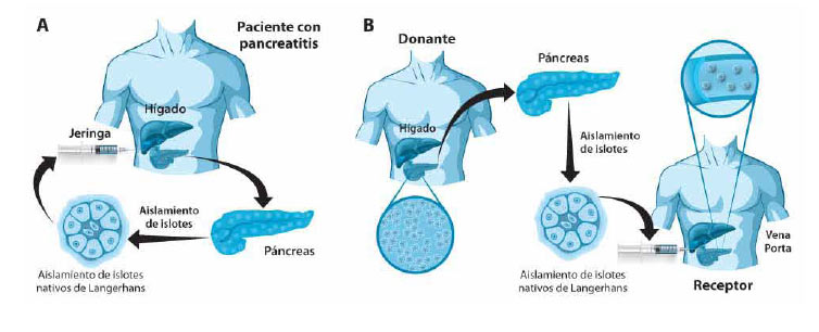 Figura 2. Trasplante de islotes con aproximación quirúrgica a través de la vena porta para realizar el injerto a nivel hepático; A) Autoinjerto de islotes en paciente con pancreatitis, infusión de células nativas funcionales por la vena porta, B) Aloinjerto de islotes provenientes de donante (vivo o cadavérico) a paciente con diabetes, infusión de células funcionales por la vena porta