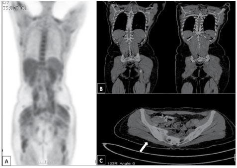 Figura 1. PET con 18-FDG (A) y (B). Muestra hipermetabolismo difuso en músculos del esqueleto axial y apendicular. (C) Sitio de mayor metabolismo a nivel de región glútea o músculo cuadriceps izquierdo (flecha blanca)