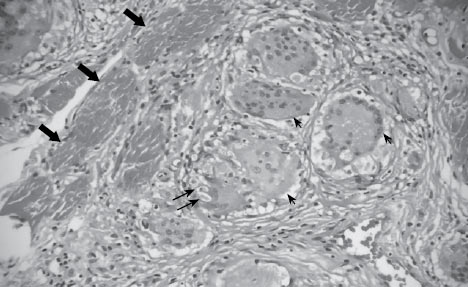 Figura 2. Biopsia de músculo glúteo mayor izquierdo. Fibras musculares (flechas negras gruesas). Hallazgos microscópicos demuestran inflamación granulomatosa con células gigantes multinucleadas (cabeza de flechas) la mayoría de ellas de cuerpo extraño con algunos cuerpos asteroides sin necrosis (flechas negras delgadas) y rodeadas por inflamación linfocítica con fibrosis alrededor que sugiere granuloma sarcoideo.
