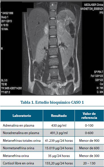 Figura 1. Lesiones sólidas dependientes de las glándulas adrenales. Nótese el mayor tamaño de la masa izquierda.