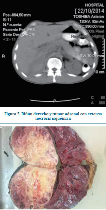 Figura 4. Masa heterogénea en el polo superior del riñón derecho. CASO 2