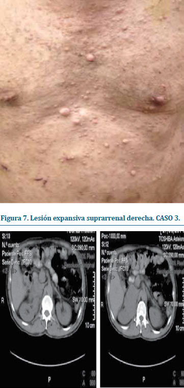 Figura 6. Lesiones múltiples en tórax compatibles con neurofibromas. CASO 3