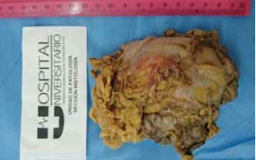 Figura 8. Masa adrenal derecha. CASO 3